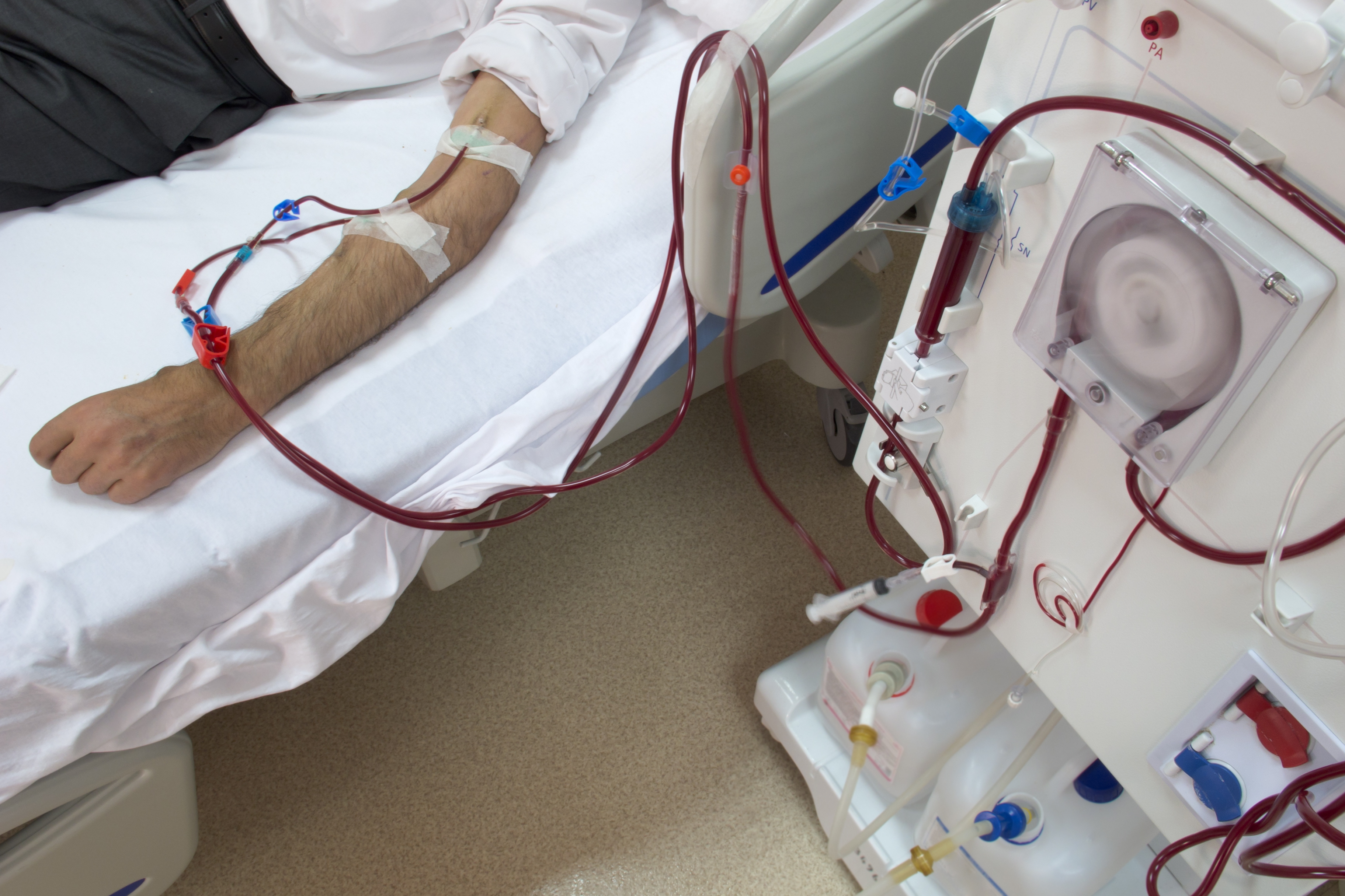 Patient in bed with tubes of blood coming from his arm and into a machine at the side of the bed.