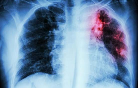 Tuberculosis.jpg